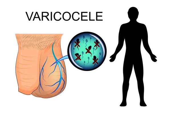 Órgano masculino que sufre de varicocele. venas dilatadas. la inactividad — Vector de stock