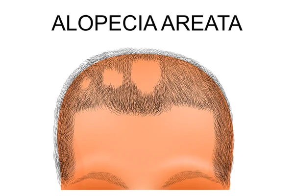 Cabeza de un hombre que sufre de alopecia areata — Vector de stock