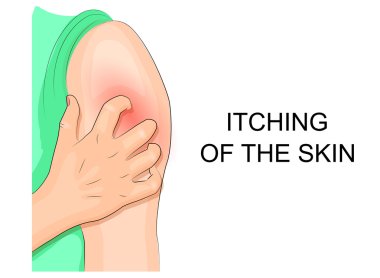 itching of the skin, infection. hand combing shoulder clipart