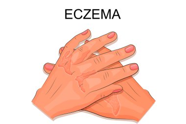 hands of a patient suffering from eczema clipart