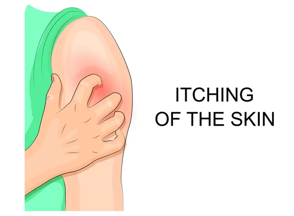 Зуд кожи, инфекция. расчесывание плеча — стоковый вектор