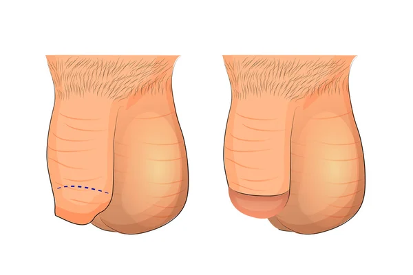 Circuncisión del prepucio del pene — Vector de stock