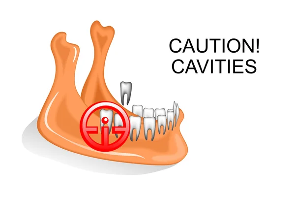 La mascella inferiore, i denti, la carie dentale — Vettoriale Stock