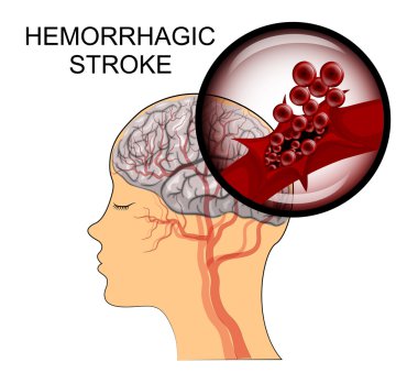 hemorrhagic  stroke. brain clipart