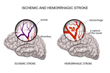 hemorrhagic and ischemic stroke clipart