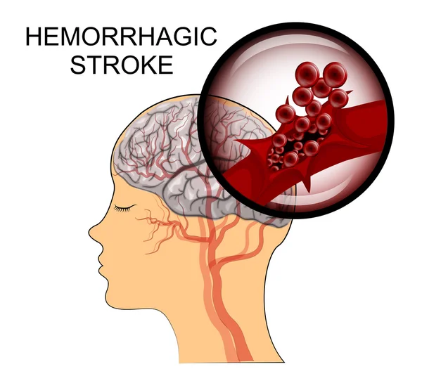 Derrame cerebral hemorrágico. cerebro — Vector de stock