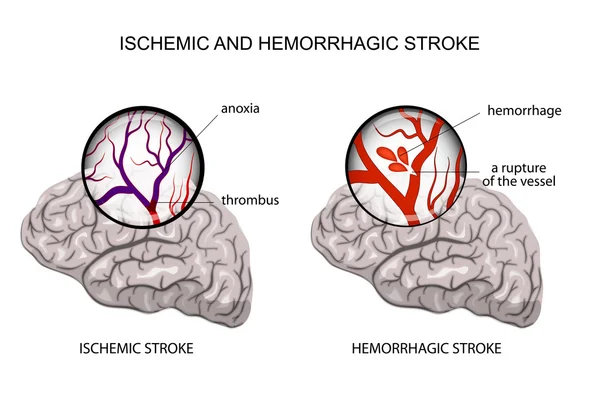 ACV hemorrágico e isquémico — Archivo Imágenes Vectoriales