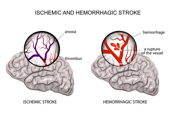 hemorrhagic and ischemic stroke