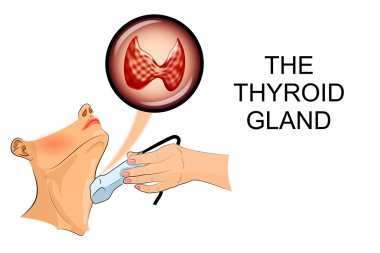 tiroid ultrasonu teşhis