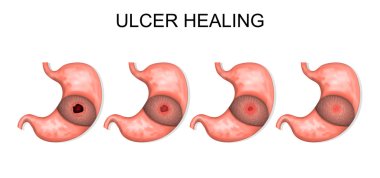 ulcer healing. gastroenterology clipart