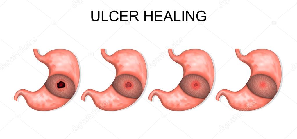 ulcer healing. gastroenterology