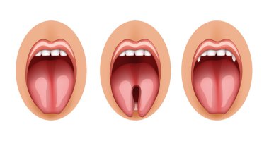  split tongue and fangs graft clipart