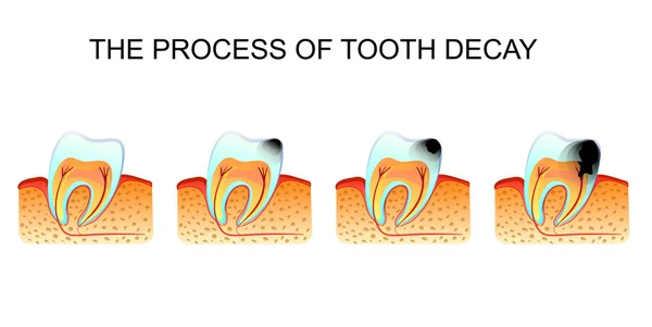 La derrota de la caries dental — Vector de stock