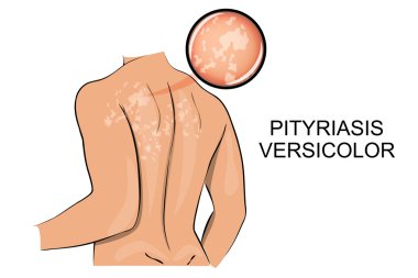 Pityriasis versicolor. Dermatoloji.