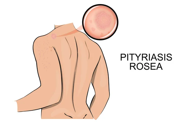 La pelle colpita da tigna rosa. pityriasis rosea . — Vettoriale Stock