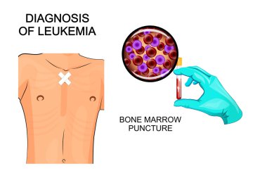 diagnosis of leukemia. Bone marrow puncture clipart