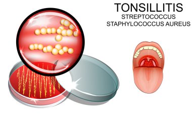angina. strep. the causative agent of the infection. bacterial s clipart