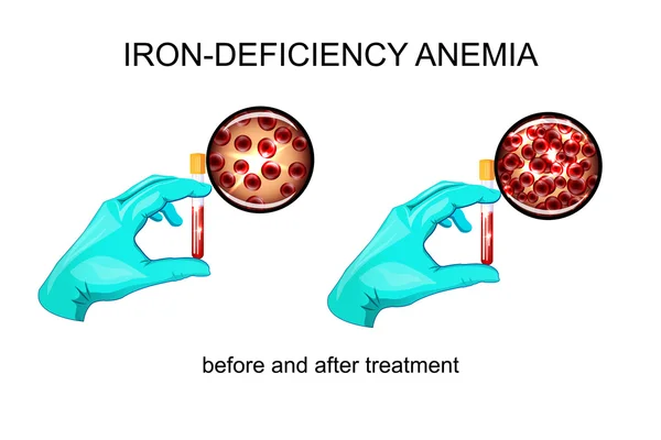 Sangre in vitro. glóbulos rojos para la anemia por deficiencia de hierro — Vector de stock