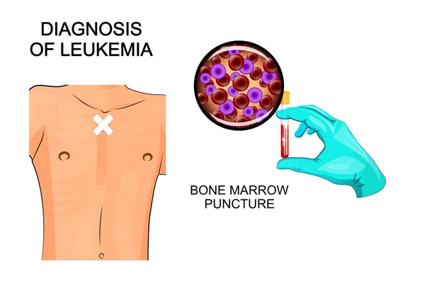 Diagnóstico de leucemia. Punção da medula óssea —  Vetores de Stock