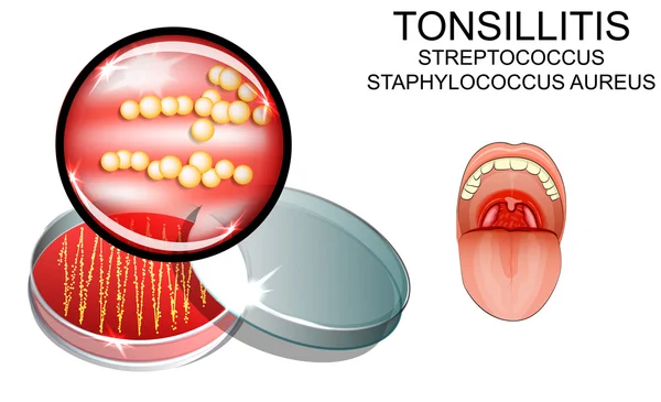 Angina. Estreptococo. el agente causal de la infección. bacterianas — Vector de stock