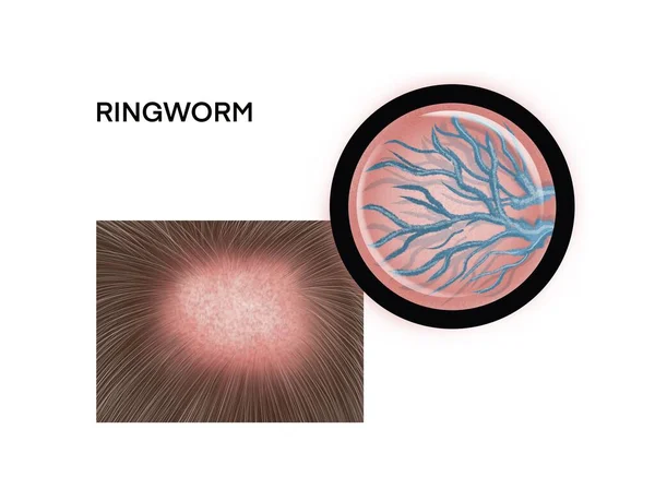 Ιατρική Απεικόνιση Του Ringworm — Φωτογραφία Αρχείου