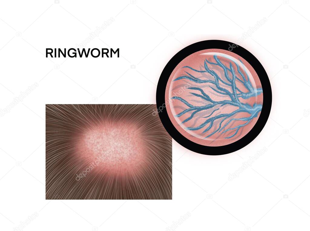 Medical illustration of the ringworm