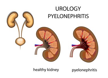 urology, kidney, pyelonephritis clipart