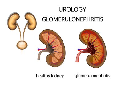 urology, kidney, glomerulonephritis clipart