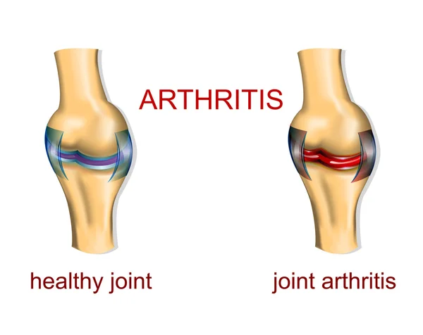 Gezamenlijke artritis — Stockvector