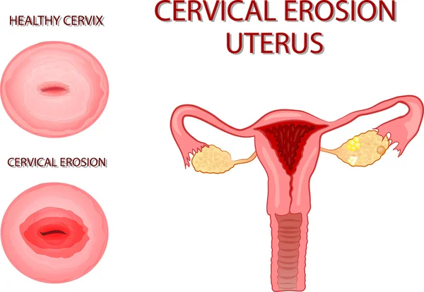 Cervical erosion. uterus — Stock Vector