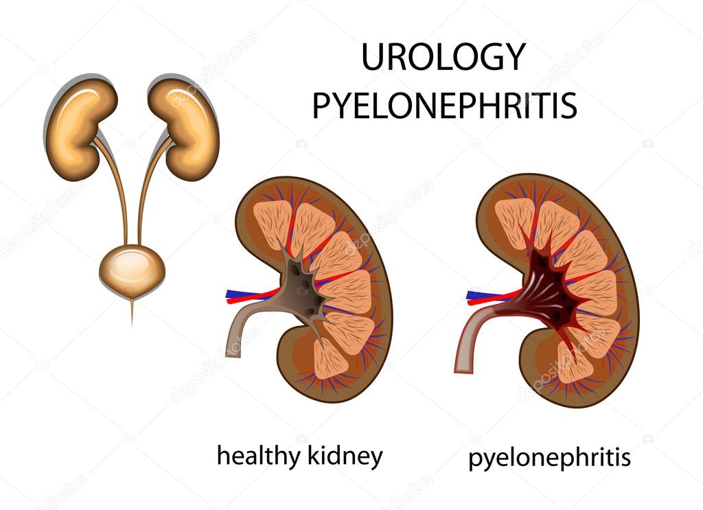 urology, kidney, pyelonephritis