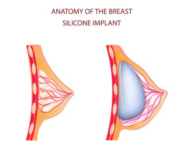 anatomy of breast silicone implant clipart