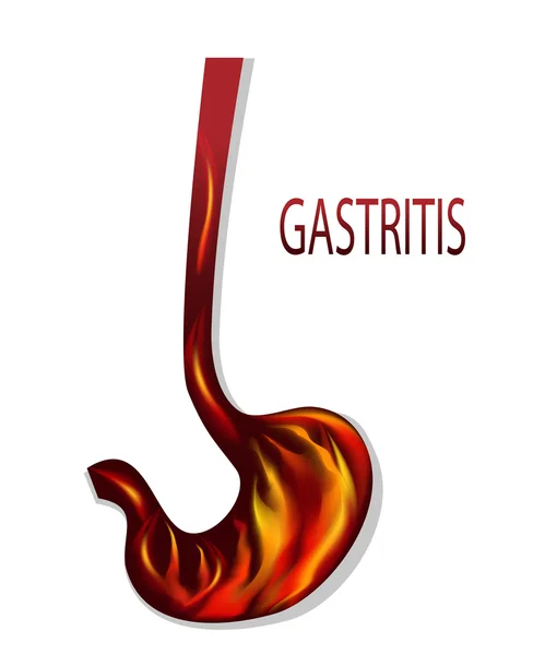 Ardor de estómago, gastritis — Vector de stock