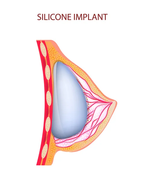 Siliconen implantaat — Stockvector