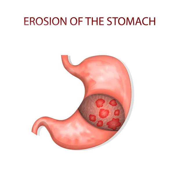 Erosión del estómago — Vector de stock