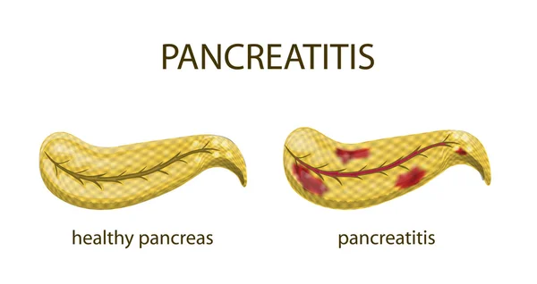 Pancreas healthy and pancreatitis — Stock Vector