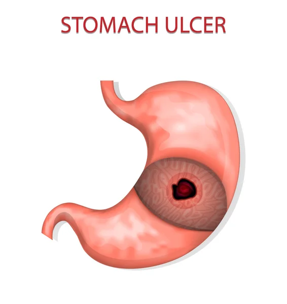 Stomach ulcer — Stock Vector