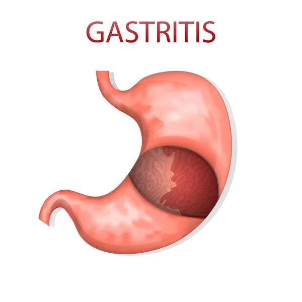 Maag, gastritis — Stockvector