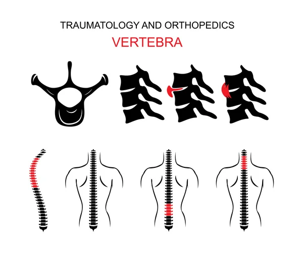 Traumatológiai és ortopédia. A gerinc. Csigolya. — Stock Vector