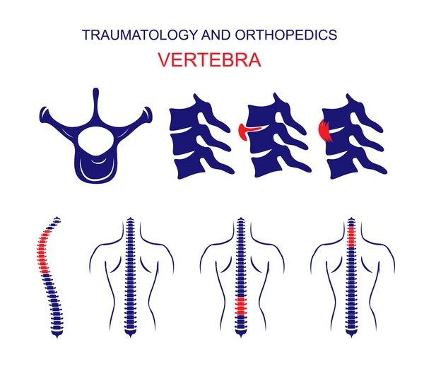 TRAUMATOLOGY AND ORTHOPEDICS. The SPINE. VERTEBRA. — Stock Vector