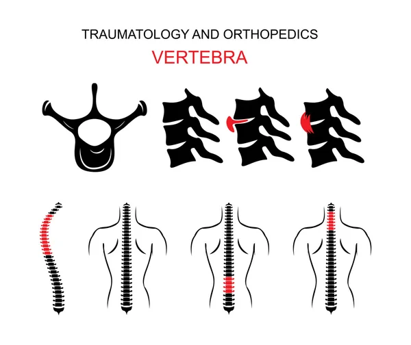 TRAUMATOLOGIA E ORTOPEDICOS. A espinha dorsal. VERTEBRA . —  Vetores de Stock