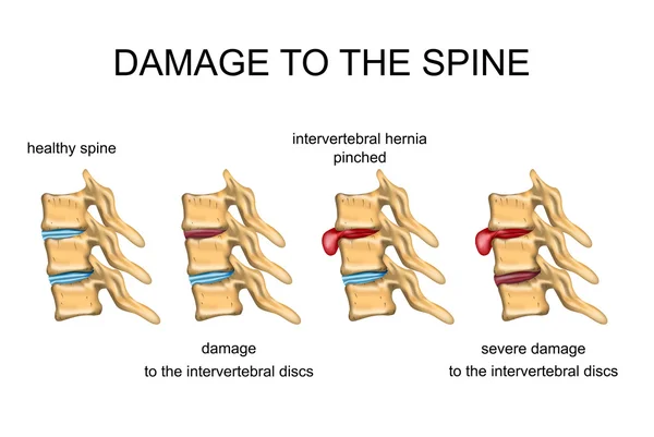 DAMAGE TO THE SPINE — Stock Vector