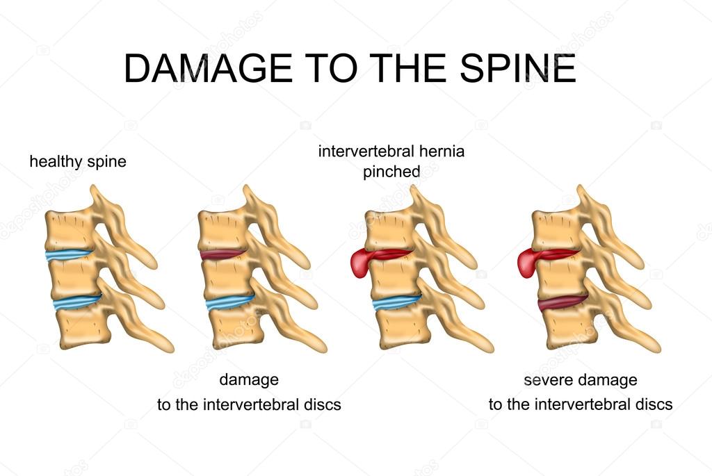 DAMAGE TO THE SPINE