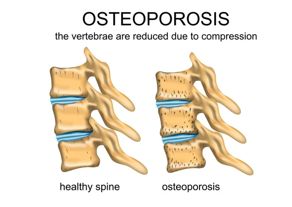 Osteoporose — Stockvector