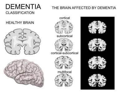 dementia, Alzheimers disease clipart