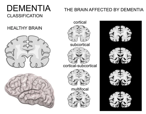 Demencia, enfermedad de Alzheimer — Vector de stock