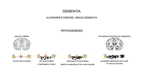 Dementia, Alzheimers disease. pathogenesis — Stock Vector