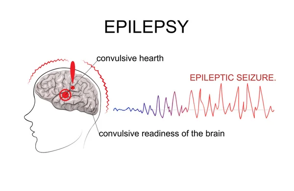EPILEPSY, facteurs d'émergence — Image vectorielle