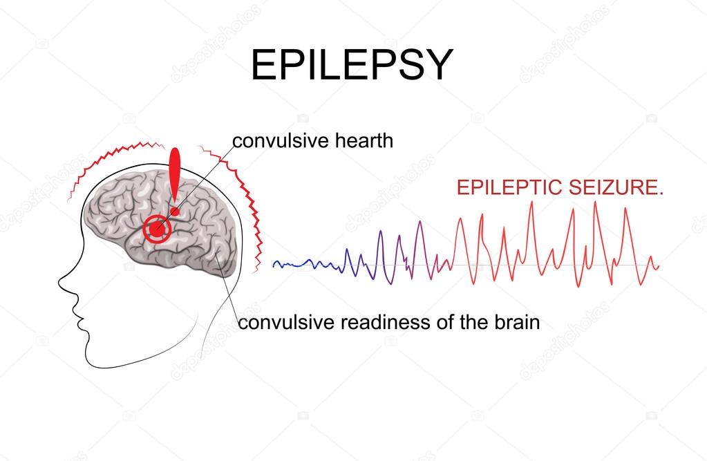 EPILEPSY, factors of emergence