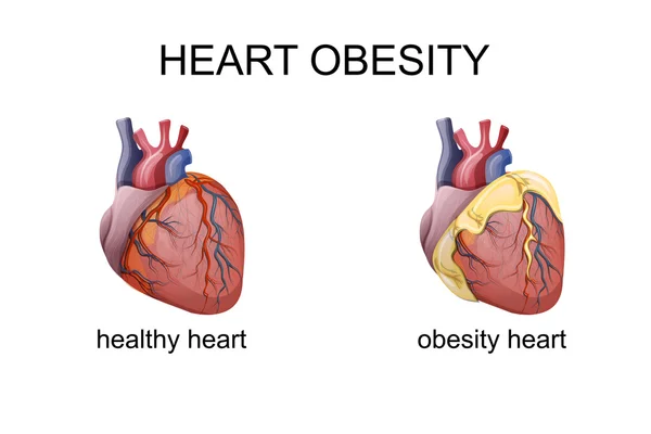 Ожирение сердца — стоковый вектор